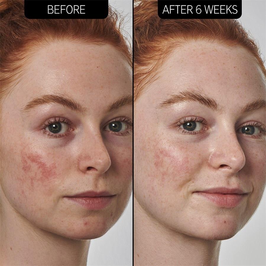 The INKEY List Sieri SuperSolutions 10% Azelaic Acid Serum Solo un giorno rimasto